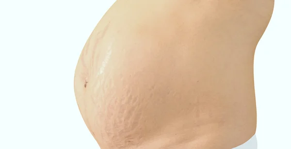 bir karın çatlakları ile closeup.