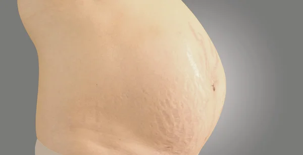 bir karın çatlakları ile closeup.