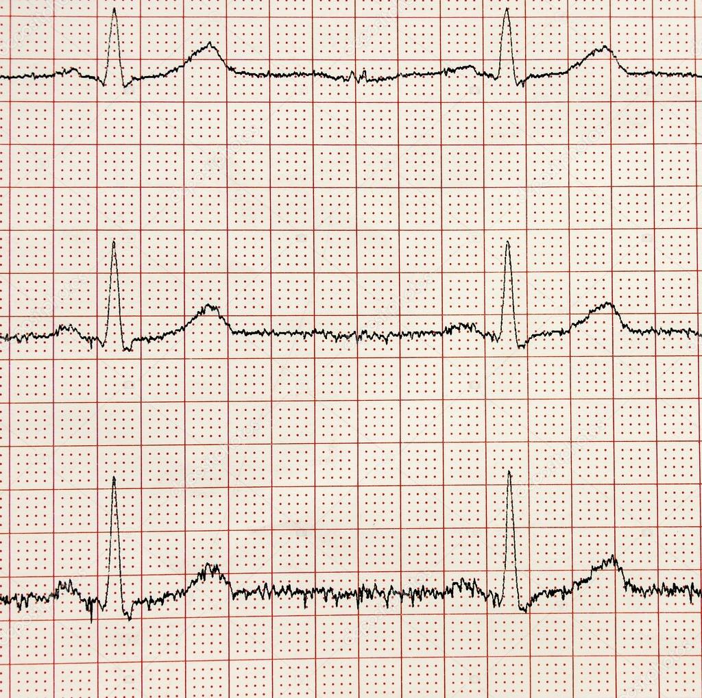 Electro-encephalogramme