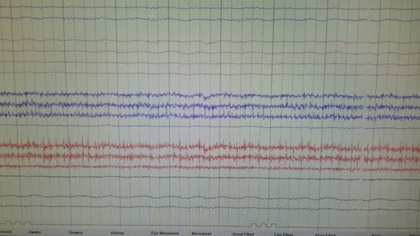 EEG Mostrando Traços de Ondas Cerebrais de Múltiplas Chumbo — Vídeo de Stock
