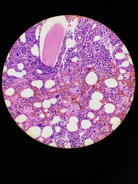 Bone marrow biopsy H and E stain showing eosinophilia — Stock Photo, Image
