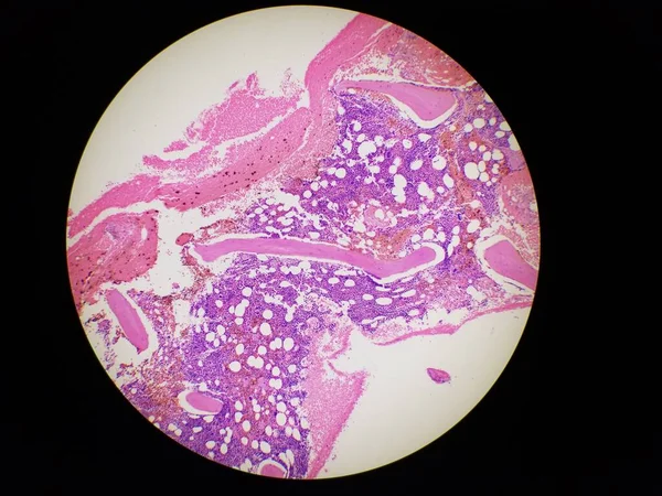 Kemik iliği biyopsisi H ve E lekeleri eozinofili gösteriyor. — Stok fotoğraf