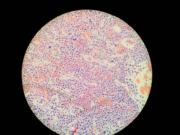 Plasmablastic Anaplastic Multiple Myeloma - Plasmacytoma Biopsy Зразки — стокове фото