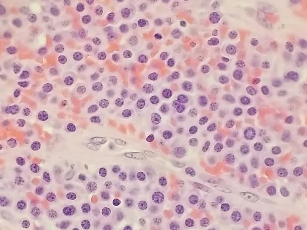 Mieloma múltiple anaplásico plasmablástico: muestra de biopsia de plasmocitoma —  Fotos de Stock