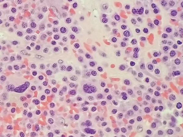 Plasmablastic αναπλαστικό πολλαπλό μυέλωμα - Κοντινό πλάνο των κυττάρων πλάσματος Εικόνα Αρχείου