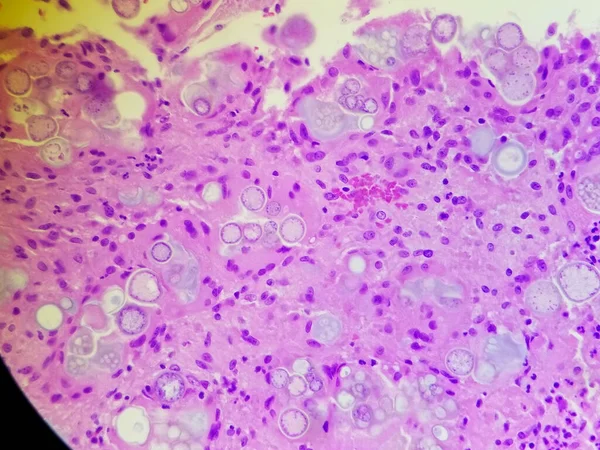 Σφαίρες ιμίτιδας κοκκιδιοειδών σε δείγμα H και E παθολογίας — Φωτογραφία Αρχείου