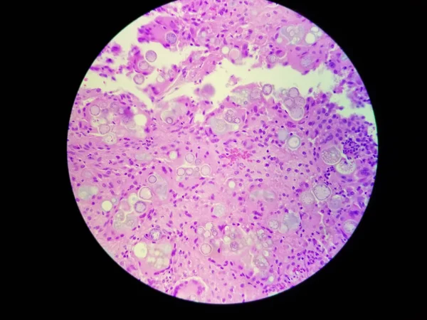 Coccidioides imitis spherules on H and E pathology specimen — 图库照片