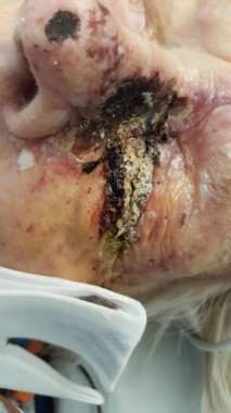 Herpes zoster of left V1 dermatomal skin