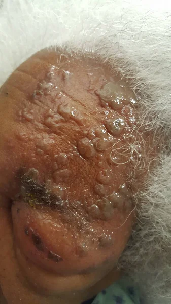 Herpes zoster of left V1 dermatomal skin - uncrusted — Stock Photo, Image
