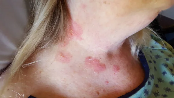 Herpes zoster of left neck skin areas — стоковое фото