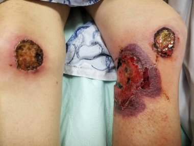 Ülserasyon, nekroz ve streptokok selüloit ile temas dermatiti.