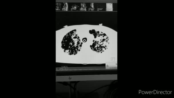 COVID-19 Pneumonia with Aspergillus Superinfection - CT Zoom — Video Stock