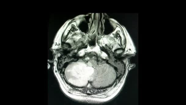 未接种COVID-19右脑和脑梗死患者 — 图库视频影像