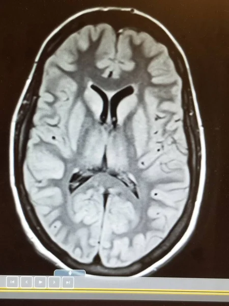 Danno cerebrale anossico con spostamento destro sulla risonanza magnetica testa — Foto Stock