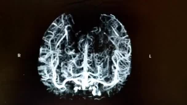 CT Angiografia mózgu - obracający się obraz czołowy w kolorze czarnym, białym — Wideo stockowe