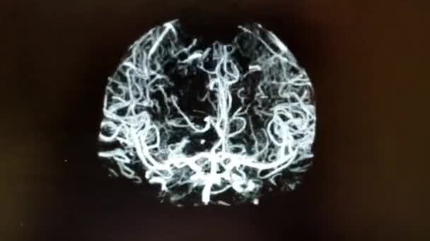 CT angiografie mozku - rotující čelní obraz v černé, bílé — Stock video