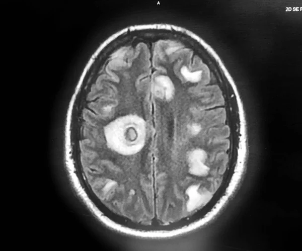 Nocardia brain abscesses and cysticercosis - MRI brain with contrast — 图库照片