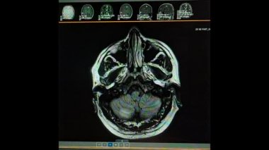 Nokardi beyin apsesi ve kistik serkoz - MRI HD video