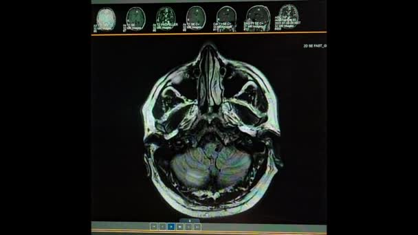 Nokardiální abscesy a cysticerkóza mozku - MRI HD video — Stock video