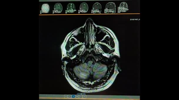 Nocardia hersenabcessen en cysticercose - MRI HD video — Stockvideo