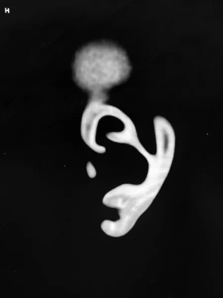 CT der Ohrmuscheln, Ohrknorpel - schwarz, weiß — Stockfoto