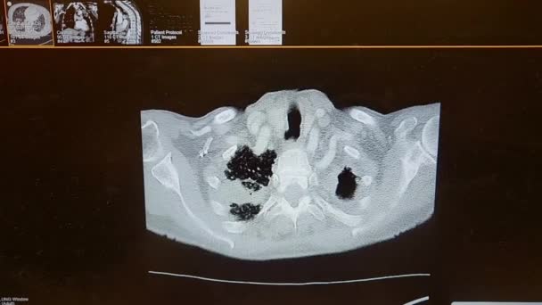 CT peito HD vídeo - Mycobacterium chelonei infecção — Vídeo de Stock