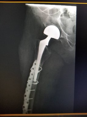 Right prosthetic hip - ORIF hardware in place