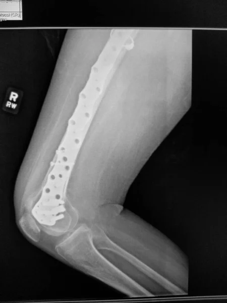 Радиограф перелома правой бедренной кости - оборудование ORIF на месте — стоковое фото