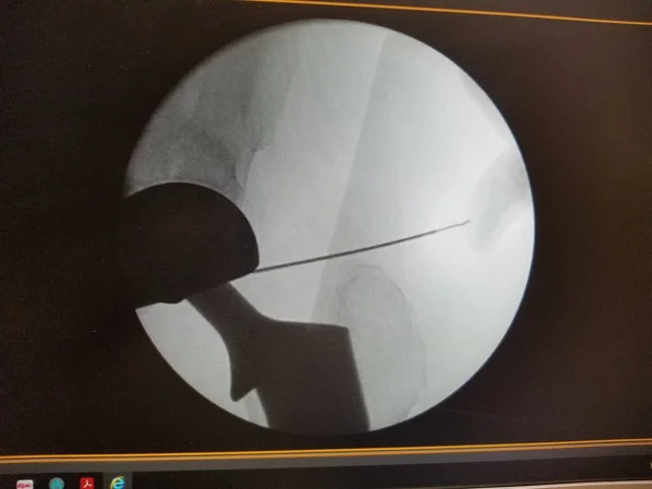 Right prosthetic hip x-ray with angiography catheter — Stock Fotó