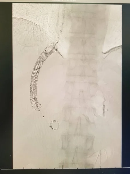 Transjugular intrahepatic portosystemic shunt -TIPS- - black, white — Stockfoto