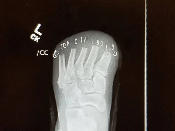Left foot transmetatarsal amputation with staples - plain x-ray — Stock Fotó
