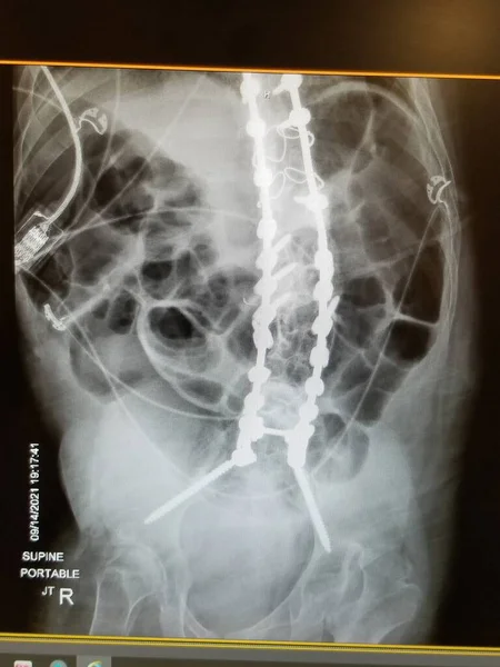 Extensive lumbar spinal fixation with scoliosis. Colonic gas also present. — Stockfoto