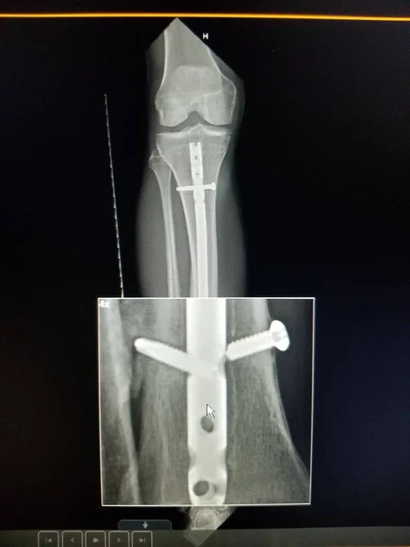 Pravá zlomenina holenní kosti se zlomeným vnitřním fixačním hardwarem Stock Obrázky