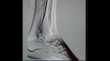 Left leg arteriogram with ankle joint