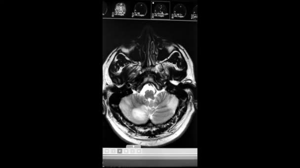 Nocardia and cysticercosis - brain CT HD movie — стоковое видео