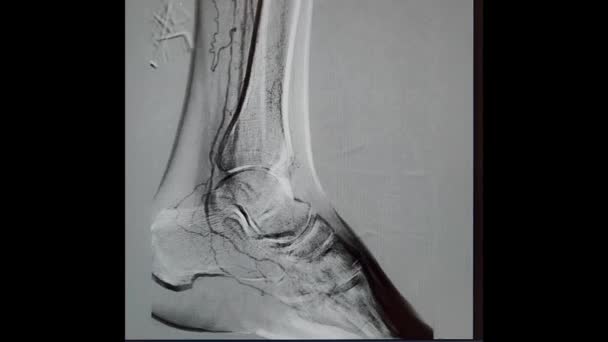 Left leg arteriogram with ankle joint — ストック動画