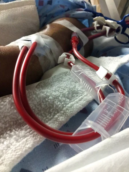 Dialysis tubing closeup with blood filtering in progress