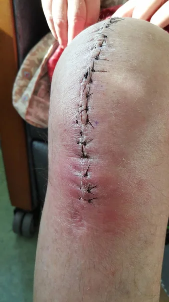 Streptococcal cellulitis - prosthetic knee surgical wound