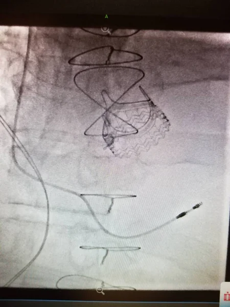 Xray showing prosthetic heart valve, sternotomy wires and pacemaker lead