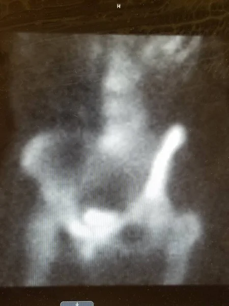 Normal pelvic bone scan, including lumbar spine