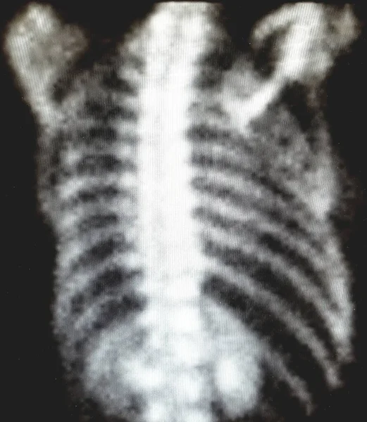 Thoracic bone scan - normal image