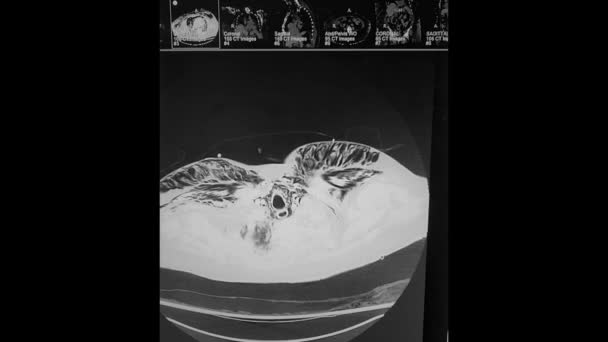 Pneumomediastinum Subcutane Emfyseem Interstitiële Pneumonie — Stockvideo