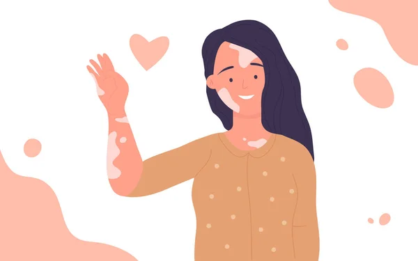 Gadis dengan masalah kulit vitiligo, wanita muda bahagia dengan patch depigmentasi tersenyum - Stok Vektor