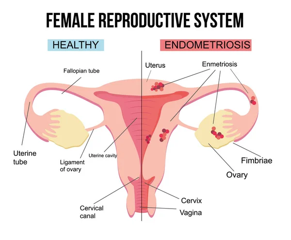 Női Reproduktív Rendszer Endometriózis Méh Nőgyógyászati Betegségeinek Rendszere Külső Szövetek — Stock Vector