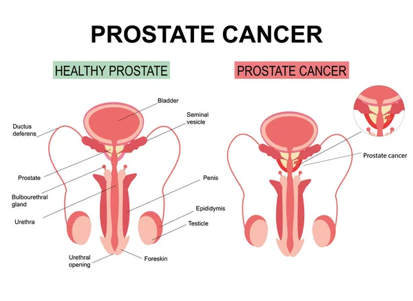 Prostate Cancer White Background Illustration Anatomy Male Reproductive Organs Healthy — Stock Fotó