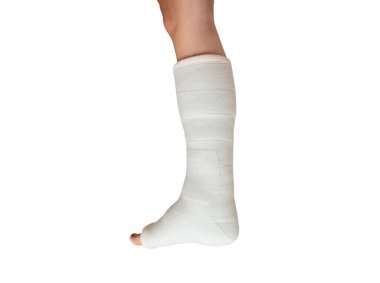 Bacağı kırık bir kadın. Bacak alçıda