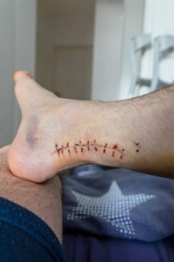 Achilles 'in tendon yırtılması ameliyatından sonra yaraya dikiş atıldı. Hastanede doktor dikişler ve cerrahi transeksiyon gösterdi. Avrupa erkek ayağına kan sıçramış.