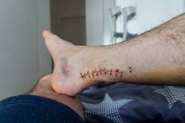 Achilles 'in tendon yırtılması ameliyatından sonra yaraya dikiş atıldı. Hastanede doktor dikişler ve cerrahi transeksiyon gösterdi. Avrupa erkek ayağına kan sıçramış.