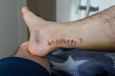 Achilles 'in tendon yırtılması ameliyatından sonra yaraya dikiş atıldı. Hastanede doktor dikişler ve cerrahi transeksiyon gösterdi. Avrupa erkek ayağına kan sıçramış.