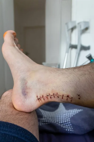 Wound suture after Achilles tendon rupture operation is treated and checked by doctor in the hospital showing stitches and operation transection with effusion of blood at European man foot